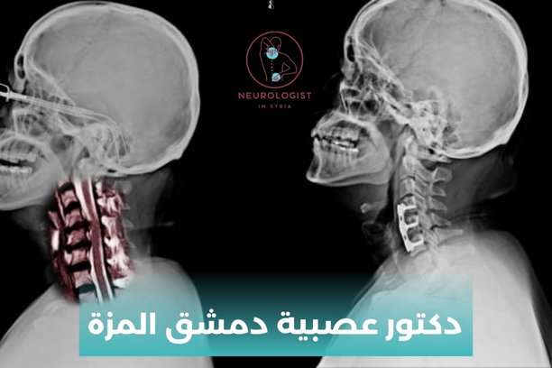 ارقام أطباء عصبية في دمشق