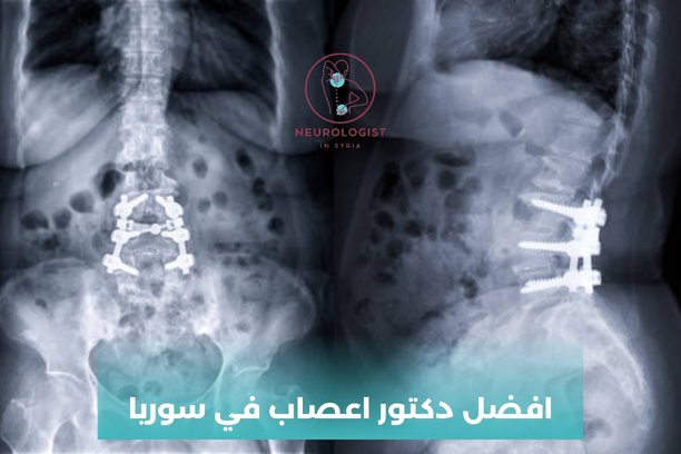 دكتور عصبية دمشق المزة دكتور عصبية دمشق المزة