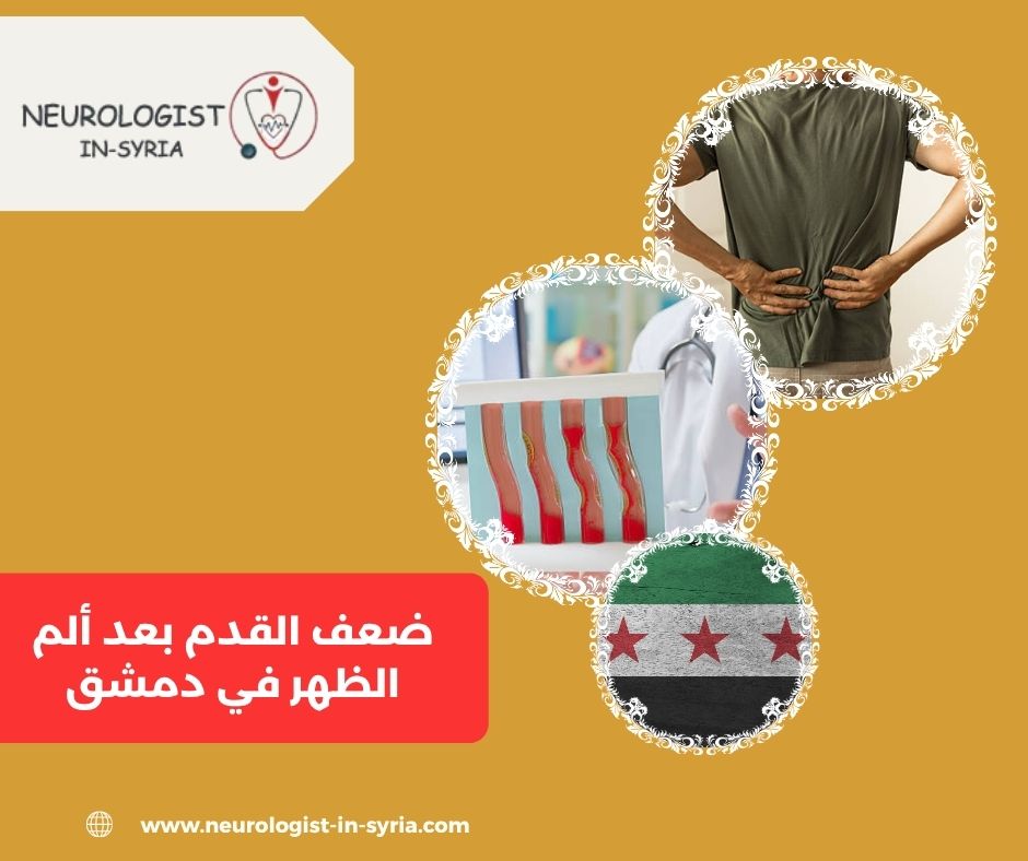 ضعف القدم بعد ألم الظهر في دمشق