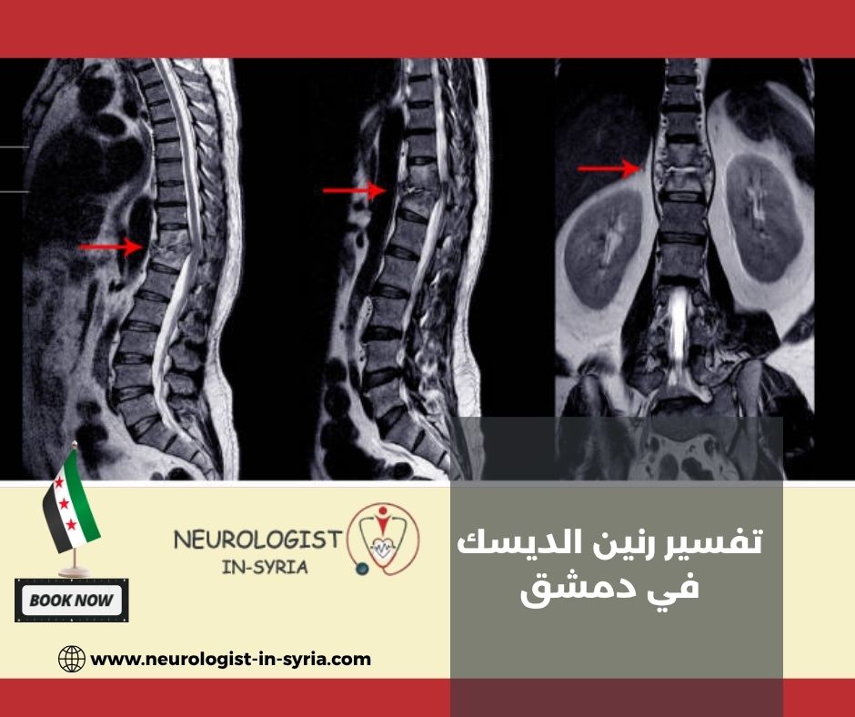 تفسير رنين الديسك في دمشق