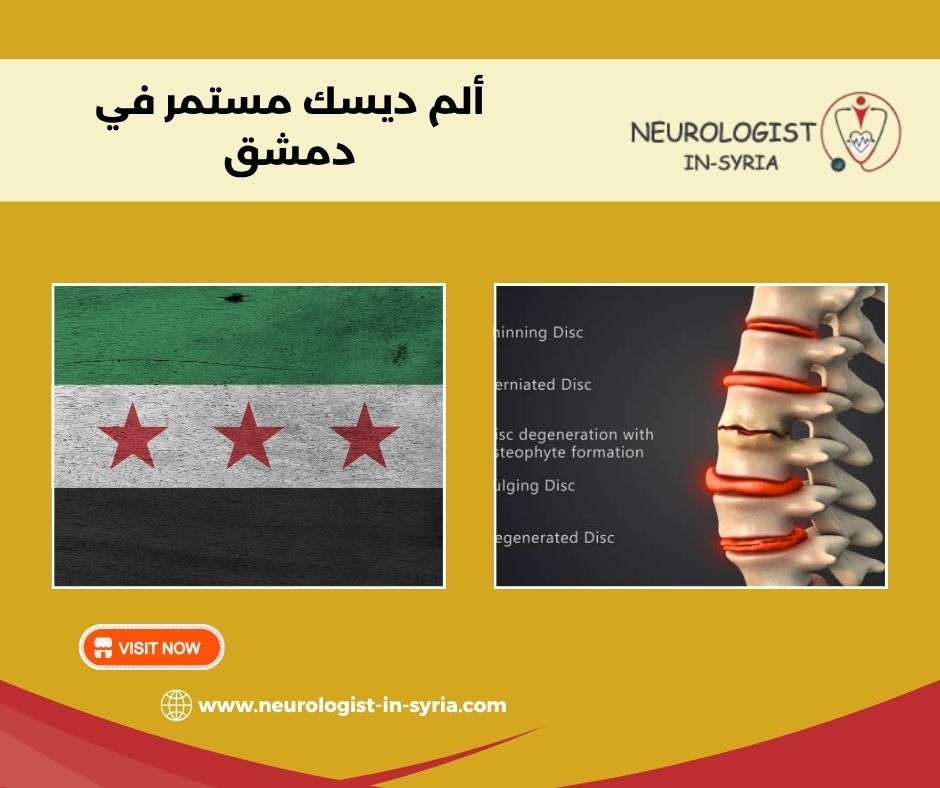 ألم ديسك مستمر في دمشق