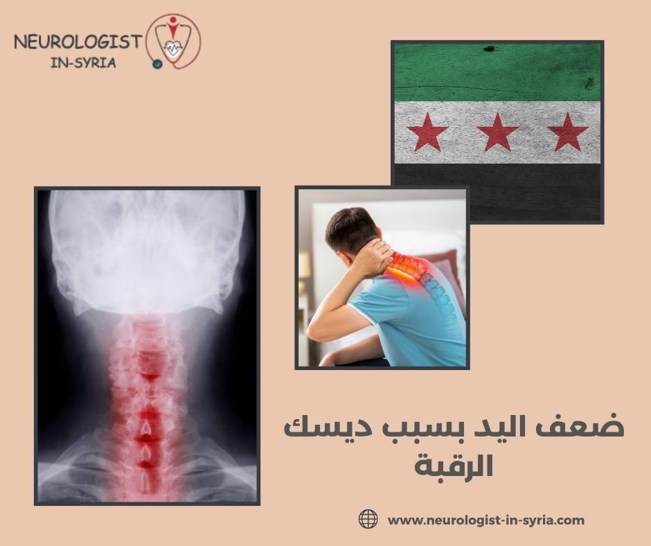 ضعف اليد بسبب ديسك الرقبة